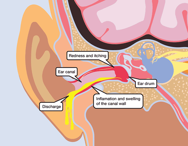 How to prevent swimmer's ear diagram